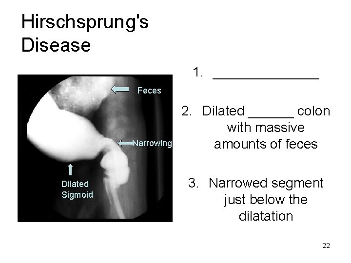 Hirschsprung's Disease 1. _______ Feces Narrowing Dilated Sigmoid 2. Dilated ______ colon with massive