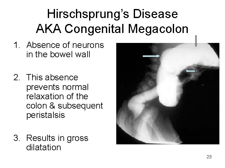 Hirschsprung’s Disease AKA Congenital Megacolon 1. Absence of neurons in the bowel wall 2.