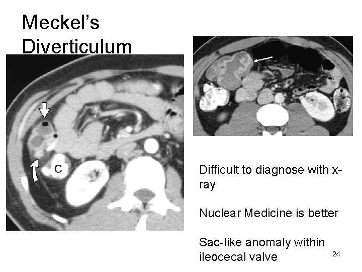 Meckel’s Diverticulum Difficult to diagnose with xray Nuclear Medicine is better Sac-like anomaly within