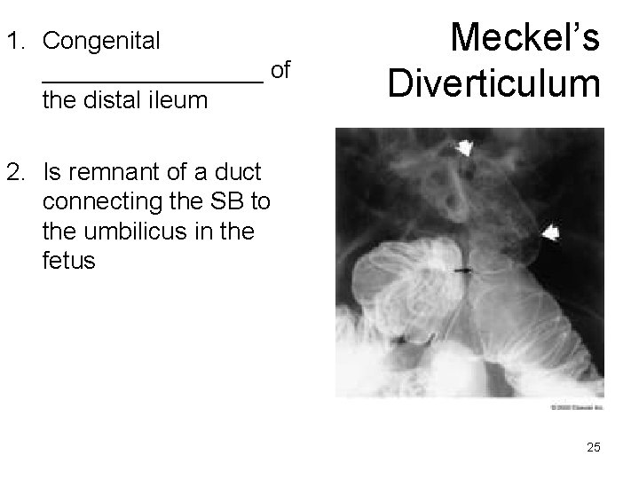 1. Congenital ________ of the distal ileum Meckel’s Diverticulum 2. Is remnant of a
