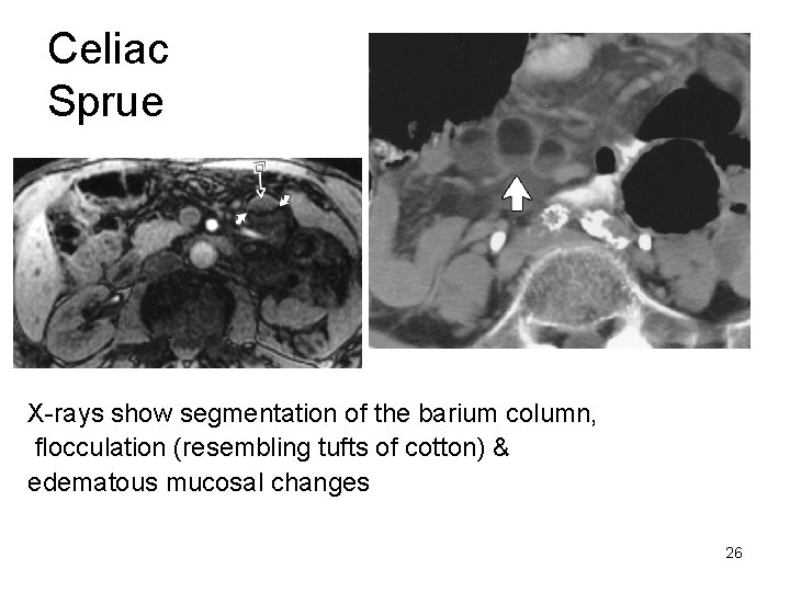 Celiac Sprue X-rays show segmentation of the barium column, flocculation (resembling tufts of cotton)