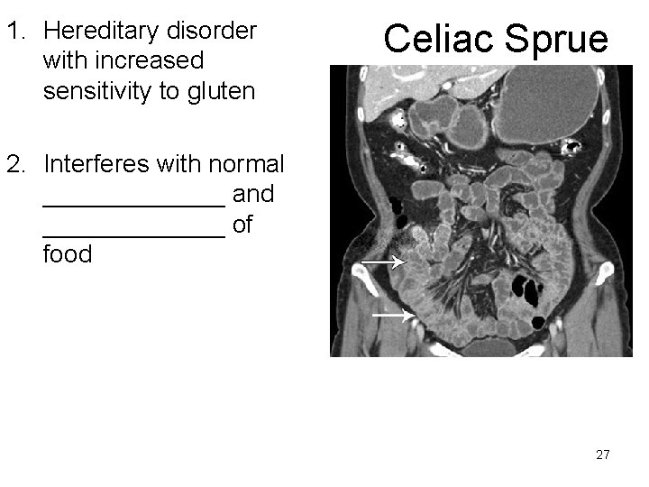1. Hereditary disorder with increased sensitivity to gluten Celiac Sprue 2. Interferes with normal
