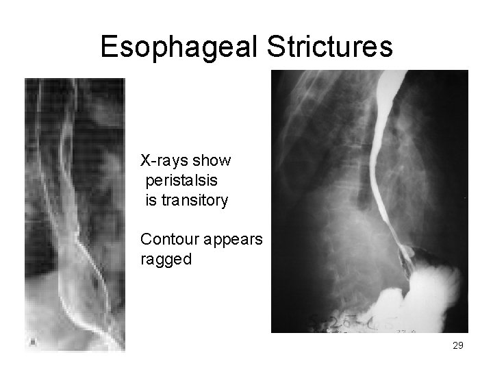 Esophageal Strictures X-rays show peristalsis is transitory Contour appears ragged 29 