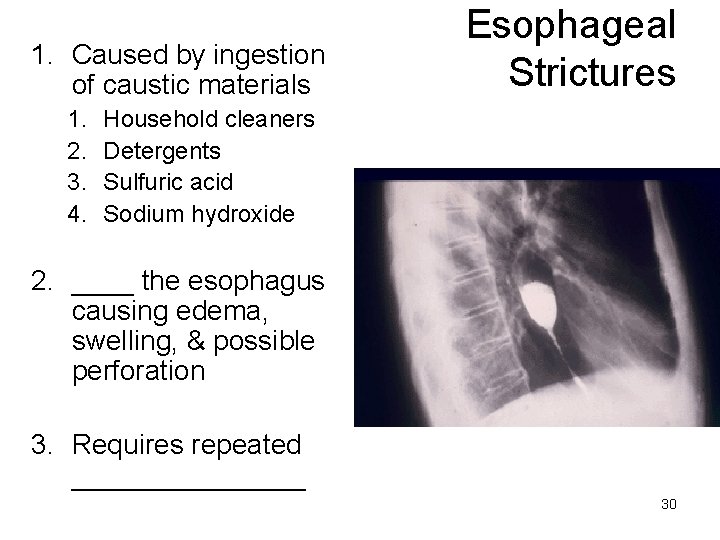 1. Caused by ingestion of caustic materials 1. 2. 3. 4. Esophageal Strictures Household