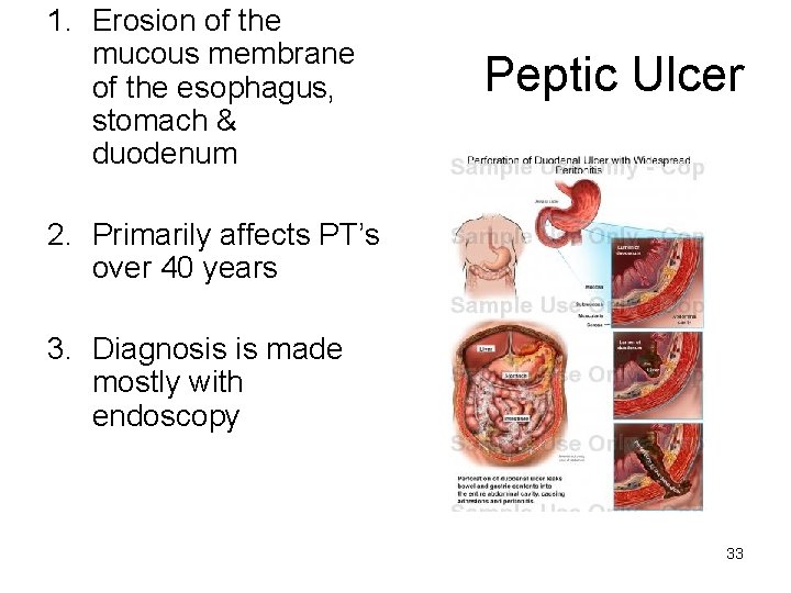 1. Erosion of the mucous membrane of the esophagus, stomach & duodenum Peptic Ulcer