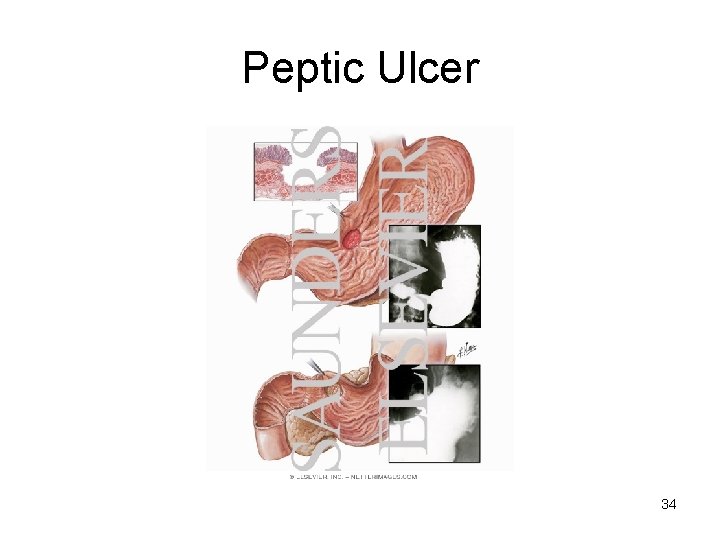 Peptic Ulcer 34 
