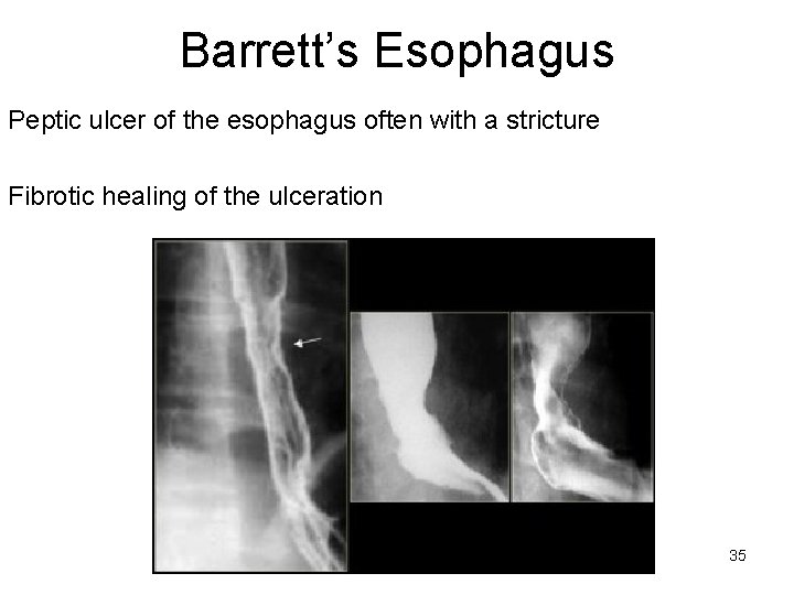 Barrett’s Esophagus Peptic ulcer of the esophagus often with a stricture Fibrotic healing of