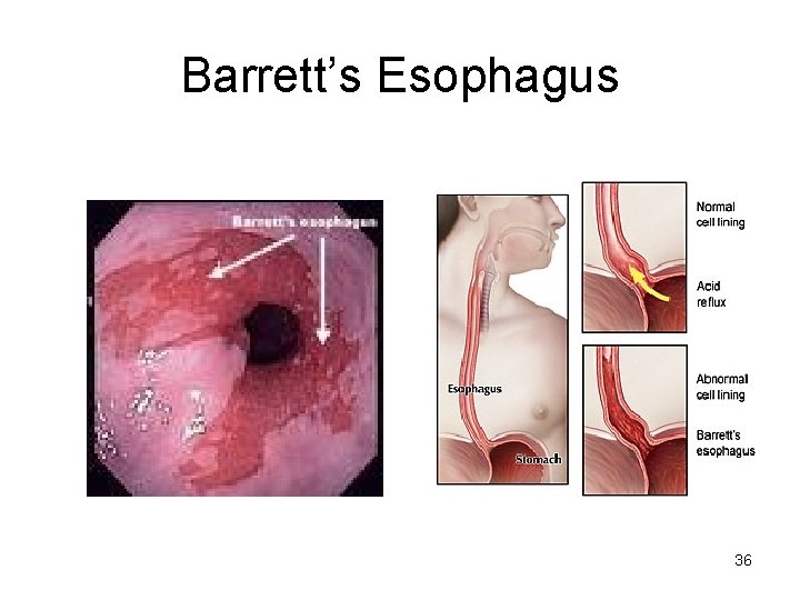 Barrett’s Esophagus 36 