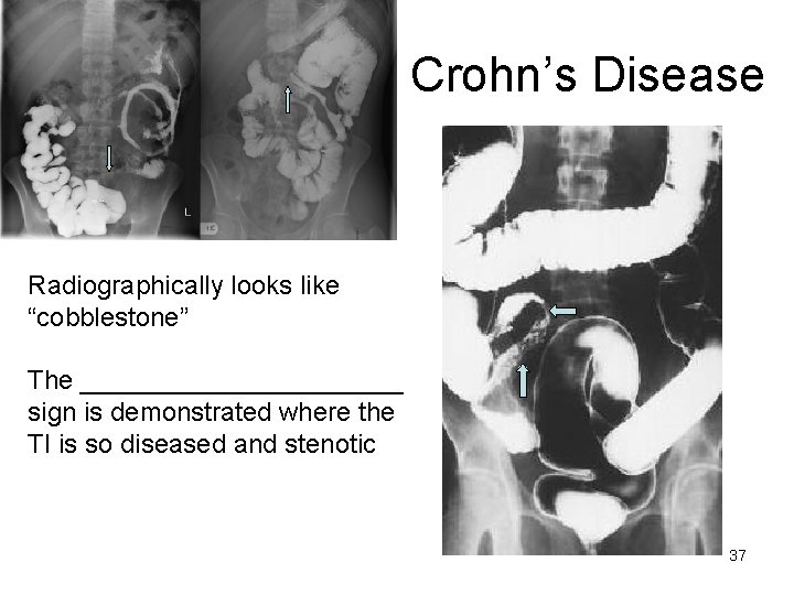 Crohn’s Disease Radiographically looks like “cobblestone” The ___________ sign is demonstrated where the TI