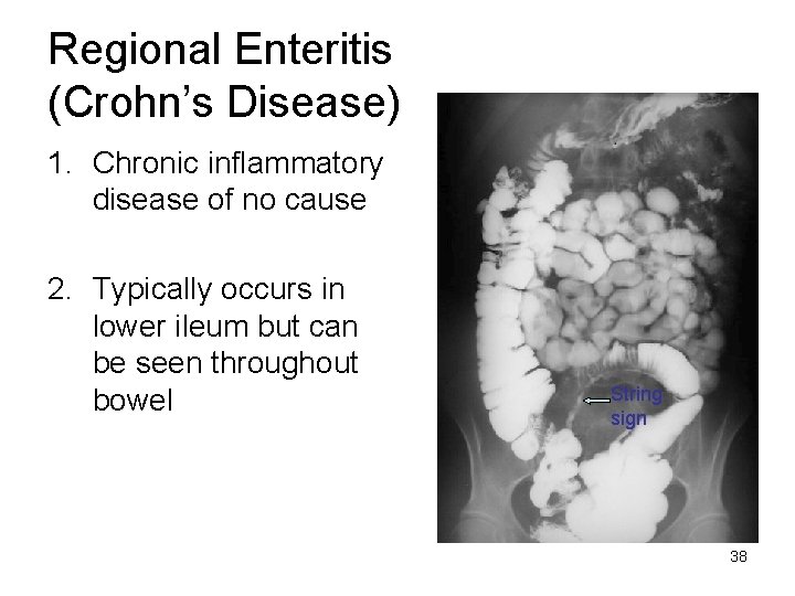 Regional Enteritis (Crohn’s Disease) 1. Chronic inflammatory disease of no cause 2. Typically occurs
