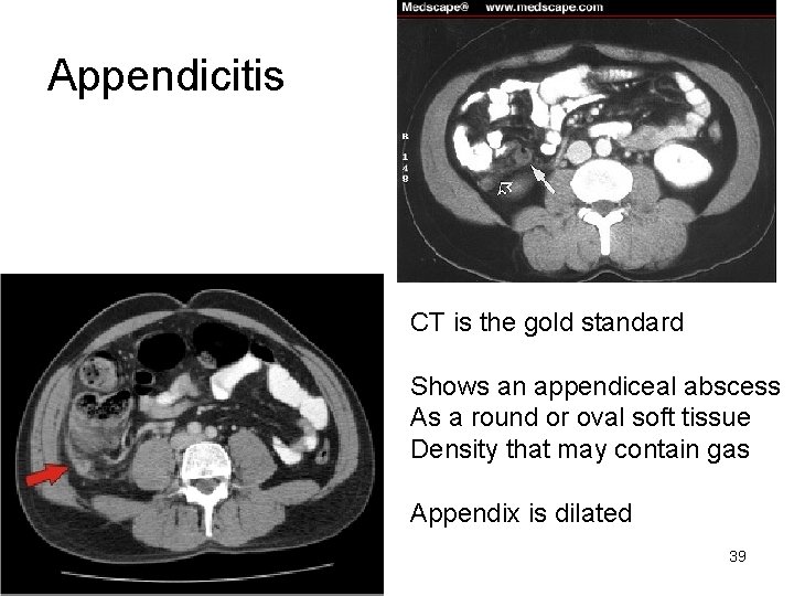 Appendicitis CT is the gold standard Shows an appendiceal abscess As a round or