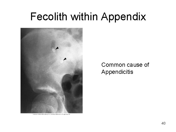 Fecolith within Appendix Common cause of Appendicitis 40 