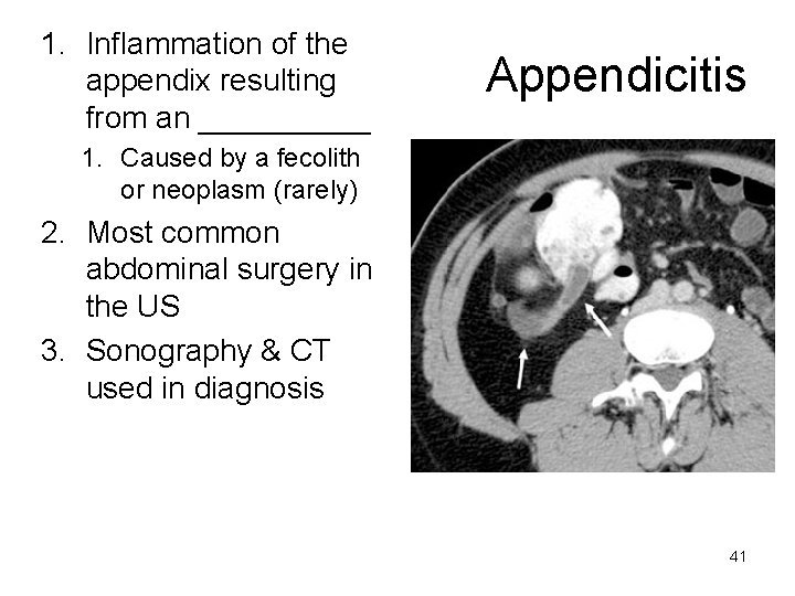 1. Inflammation of the appendix resulting from an _____ Appendicitis 1. Caused by a