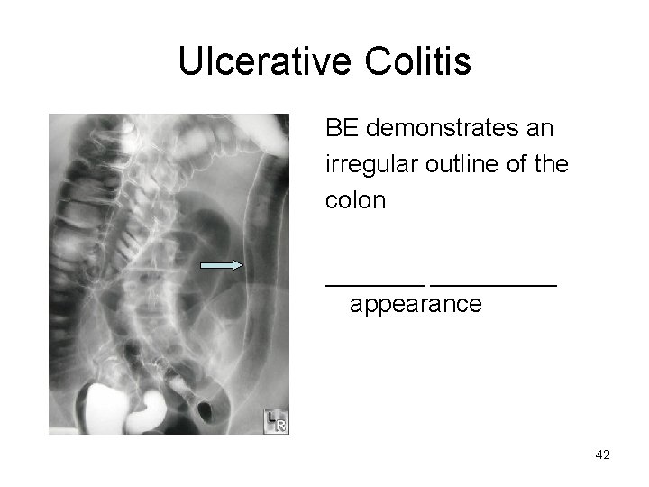 Ulcerative Colitis BE demonstrates an irregular outline of the colon _________ appearance 42 