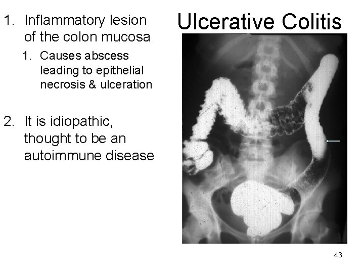 1. Inflammatory lesion of the colon mucosa Ulcerative Colitis 1. Causes abscess leading to