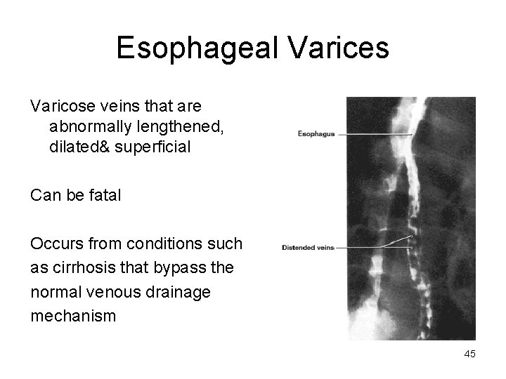 Esophageal Varices Varicose veins that are abnormally lengthened, dilated& superficial Can be fatal Occurs