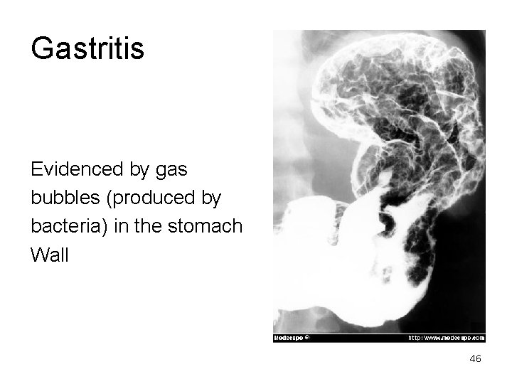 Gastritis Evidenced by gas bubbles (produced by bacteria) in the stomach Wall 46 