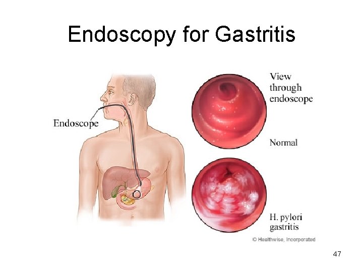 Endoscopy for Gastritis 47 