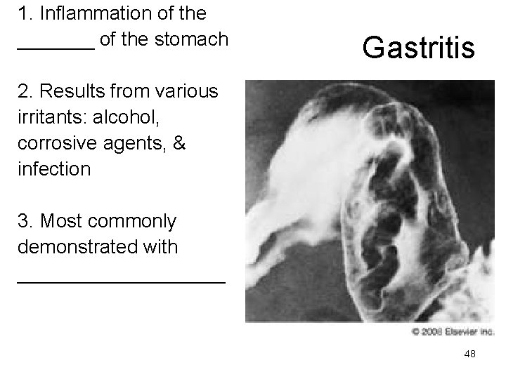 1. Inflammation of the _______ of the stomach Gastritis 2. Results from various irritants: