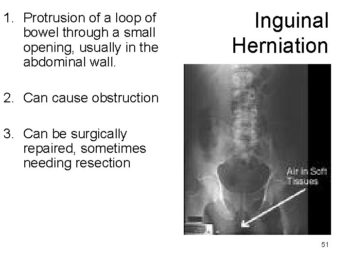 1. Protrusion of a loop of bowel through a small opening, usually in the