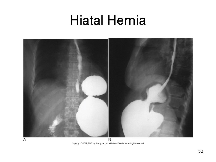 Hiatal Hernia 52 