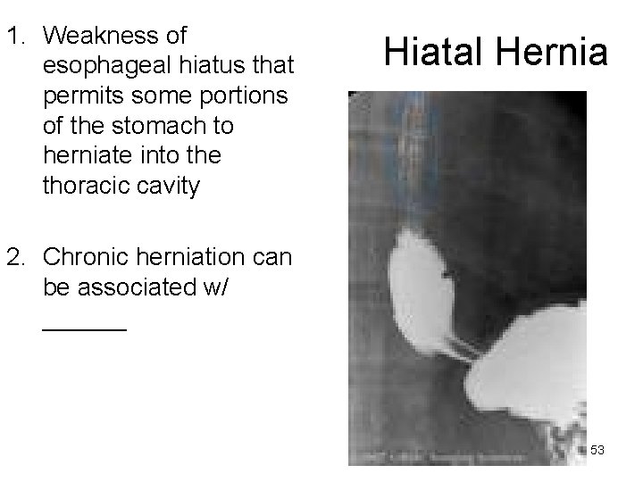 1. Weakness of esophageal hiatus that permits some portions of the stomach to herniate
