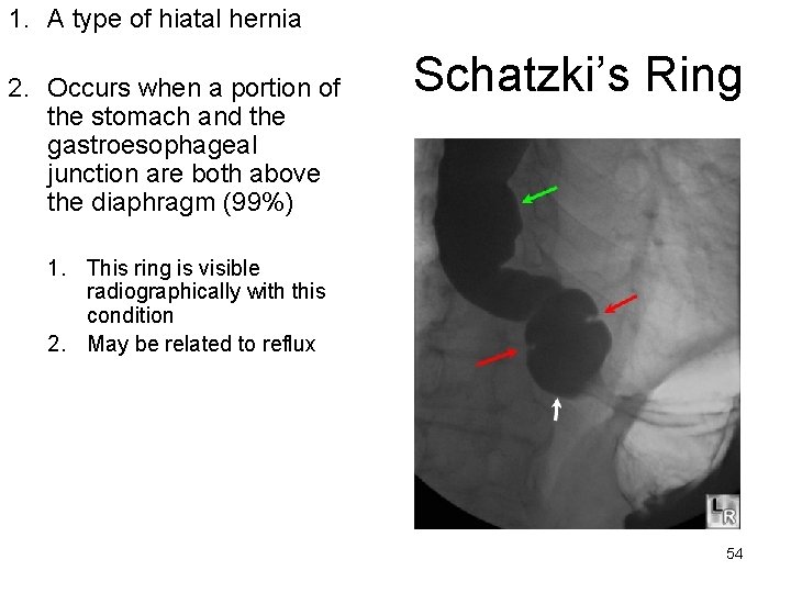 1. A type of hiatal hernia 2. Occurs when a portion of the stomach