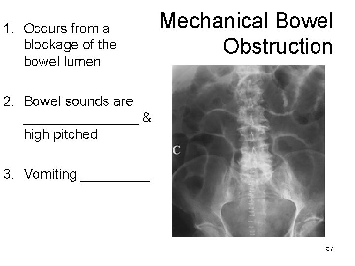 1. Occurs from a blockage of the bowel lumen Mechanical Bowel Obstruction 2. Bowel