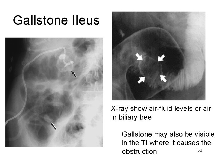 Gallstone Ileus X-ray show air-fluid levels or air in biliary tree Gallstone may also