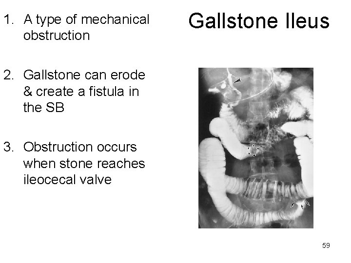 1. A type of mechanical obstruction Gallstone Ileus 2. Gallstone can erode & create