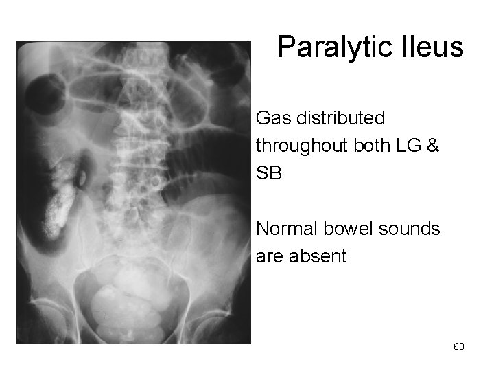 Paralytic Ileus Gas distributed throughout both LG & SB Normal bowel sounds are absent
