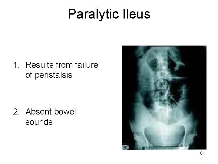 Paralytic Ileus 1. Results from failure of peristalsis 2. Absent bowel sounds 61 