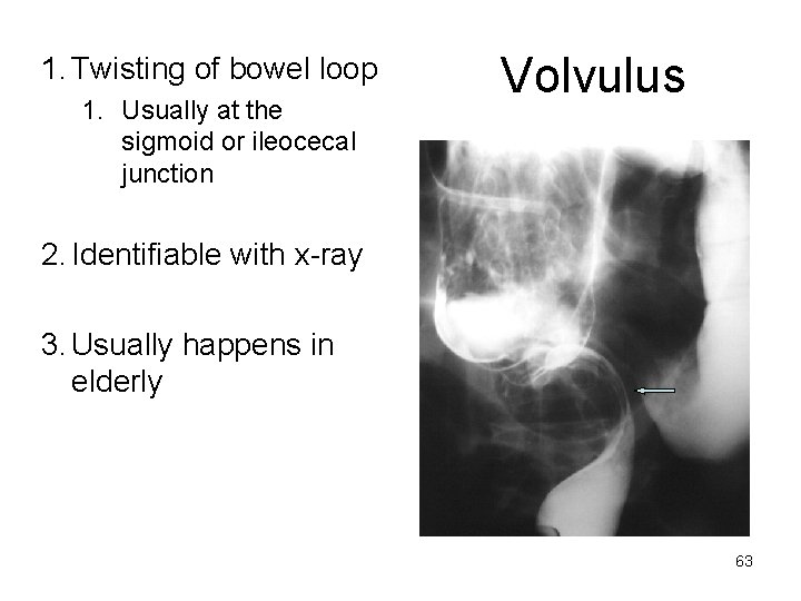 1. Twisting of bowel loop 1. Usually at the sigmoid or ileocecal junction Volvulus