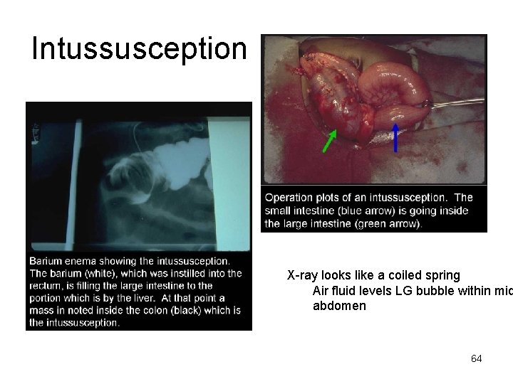 Intussusception X-ray looks like a coiled spring Air fluid levels LG bubble within mid