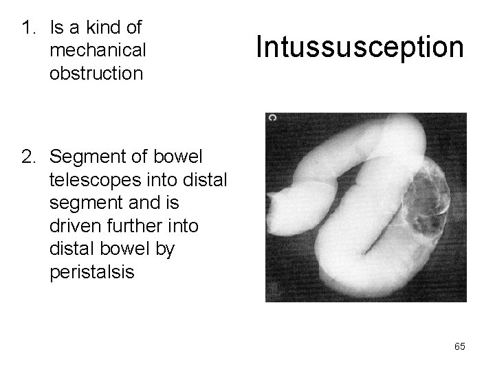 1. Is a kind of mechanical obstruction Intussusception 2. Segment of bowel telescopes into