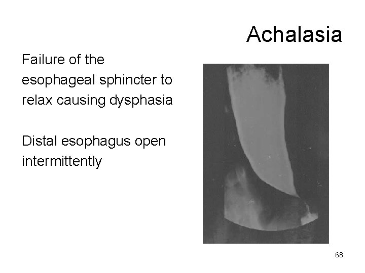 Achalasia Failure of the esophageal sphincter to relax causing dysphasia Distal esophagus open intermittently