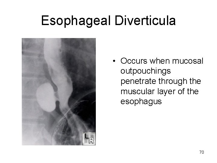 Esophageal Diverticula • Occurs when mucosal outpouchings penetrate through the muscular layer of the