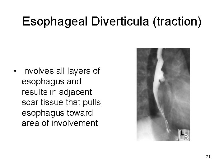 Esophageal Diverticula (traction) • Involves all layers of esophagus and results in adjacent scar
