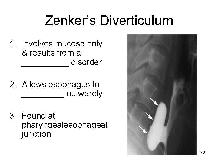 Zenker’s Diverticulum 1. Involves mucosa only & results from a _____ disorder 2. Allows