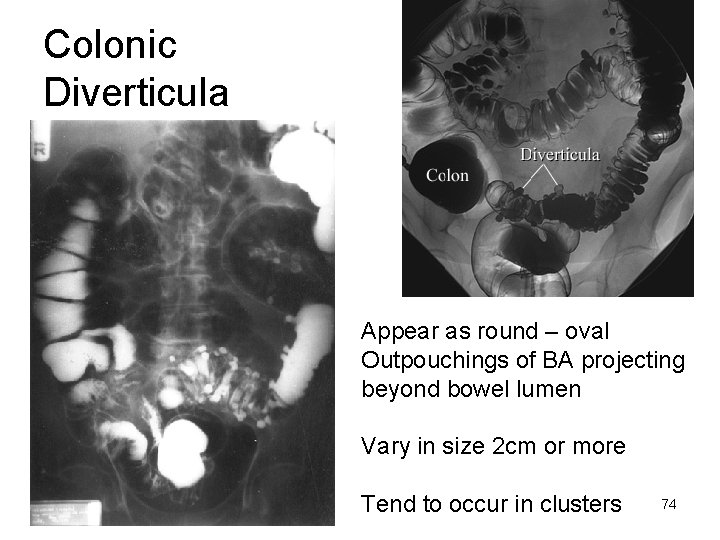 Colonic Diverticula Appear as round – oval Outpouchings of BA projecting beyond bowel lumen
