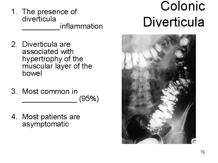 1. The presence of diverticula _____inflammation Colonic Diverticula 2. Diverticula are associated with hypertrophy