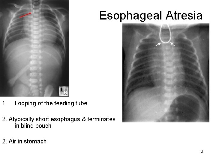 Esophageal Atresia 1. Looping of the feeding tube 2. Atypically short esophagus & terminates