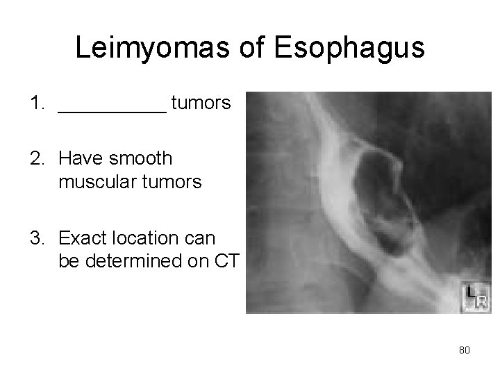 Leimyomas of Esophagus 1. _____ tumors 2. Have smooth muscular tumors 3. Exact location