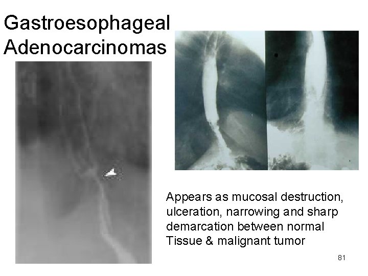 Gastroesophageal Adenocarcinomas Appears as mucosal destruction, ulceration, narrowing and sharp demarcation between normal Tissue