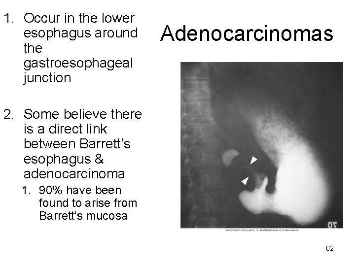 1. Occur in the lower esophagus around the gastroesophageal junction Adenocarcinomas 2. Some believe