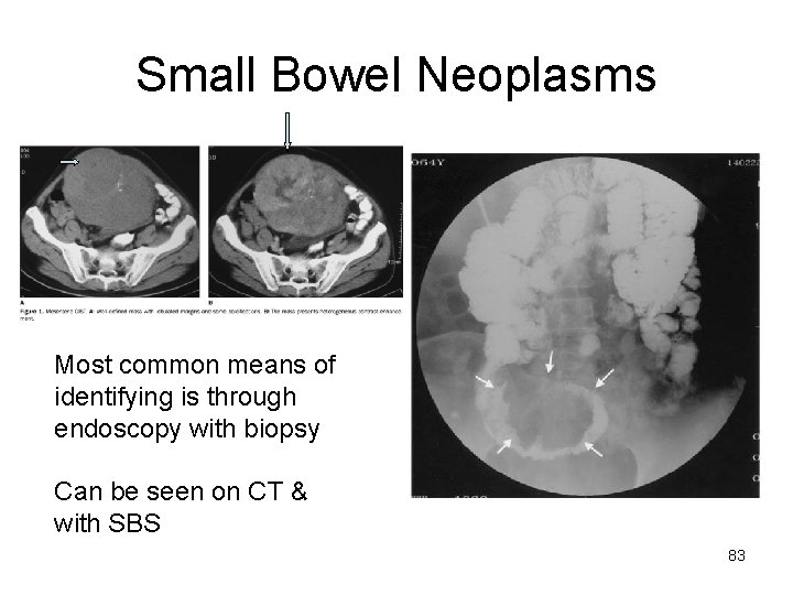 Small Bowel Neoplasms Most common means of identifying is through endoscopy with biopsy Can