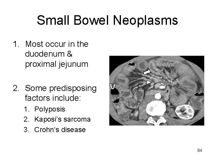 Small Bowel Neoplasms 1. Most occur in the duodenum & proximal jejunum 2. Some
