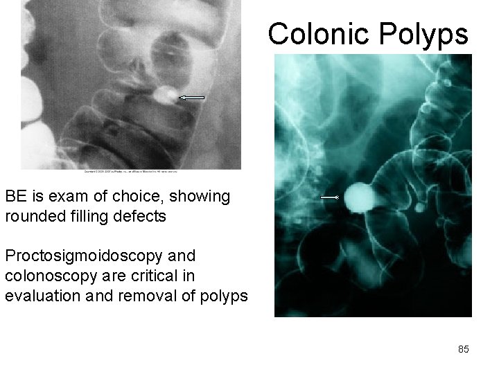 Colonic Polyps BE is exam of choice, showing rounded filling defects Proctosigmoidoscopy and colonoscopy