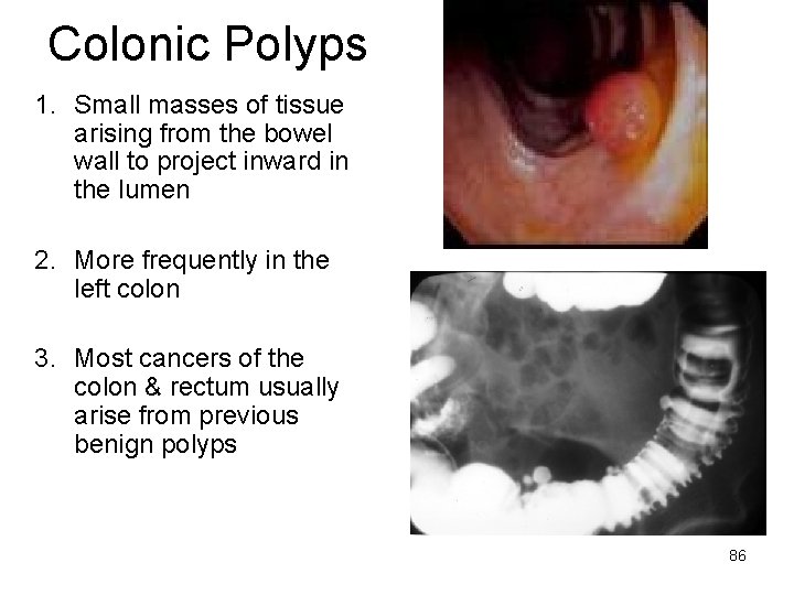 Colonic Polyps 1. Small masses of tissue arising from the bowel wall to project