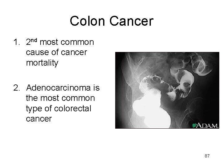 Colon Cancer 1. 2 nd most common cause of cancer mortality 2. Adenocarcinoma is
